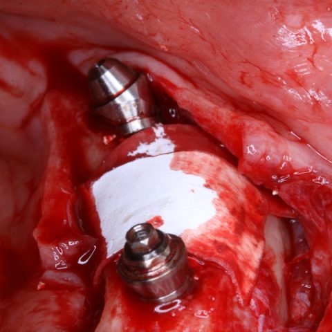 DC-Provisória-imediata-inferior-4-Implantes-colocados