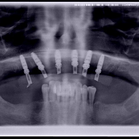 DC-Superior-5-Ortopantomografia-com-os-implantes-colocados