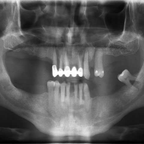 DC-Zygomáticos_1-2-Ortopantomografia
