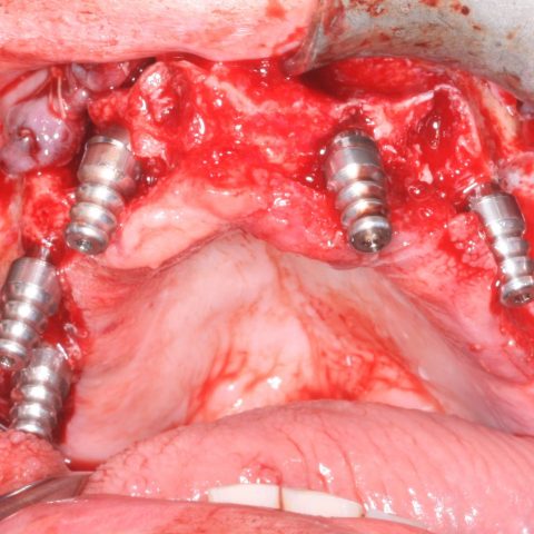 DC-Zygomáticos_1-3-Implante-zigomático