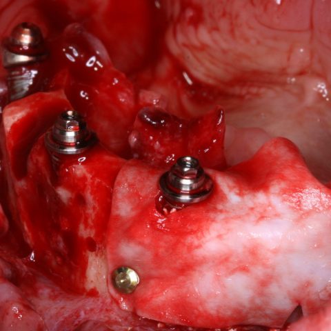 DC-Zygomáticos_1-5-Implantes-inferiores-1