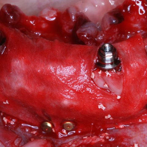 DC-Zygomáticos_1-6-Implantes-inferiores-2