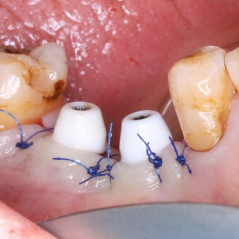 DC-Zygomáticos_2-4-Implantes-na-mandibula,-região-posterior
