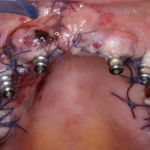 DC-Zygomáticos_2-8-Implantes-no-maxilar-com-copings-de-impressão