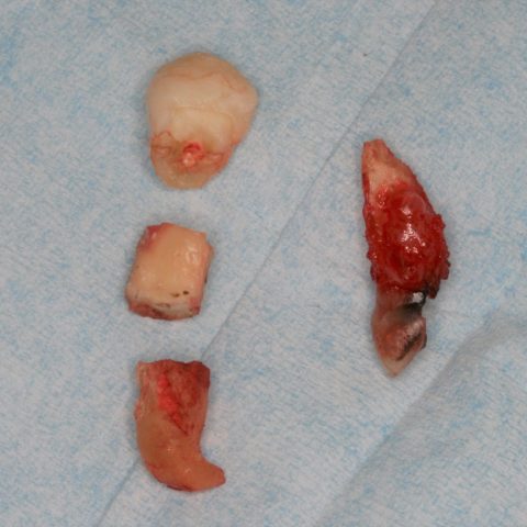 FUD-Dentes-da-frente-Canino-incluso-3-Dentes-extraidos