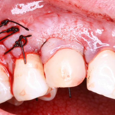 FUD-Dentes-da-frente-Canino-incluso-6-Aspeto-no-final-da-cirurgia