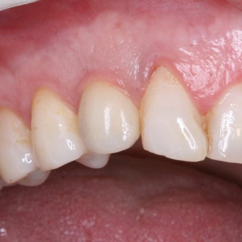 FUD-Dentes-da-frente-Canino-incluso-7-Cinco-anos-de-evolução