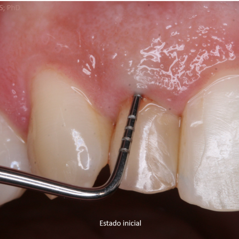 FUD-Dentes-da-frente-Incisivo-lateral_1-1-Estado-inicial