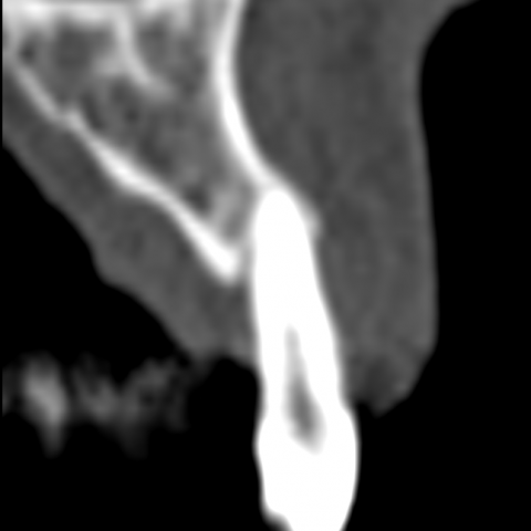 FUD-Dentes-da-frente-Incisivo-lateral_1-2-Imagem-TAC