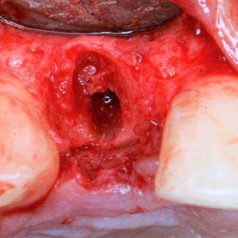 FUD-Dentes-da-frente-Incisivo-lateral_1-3-Preparação-do-leito-impantar