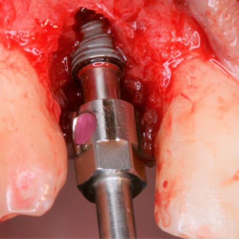 FUD-Dentes-da-frente-Incisivo-lateral_1-4-Implante-colocado
