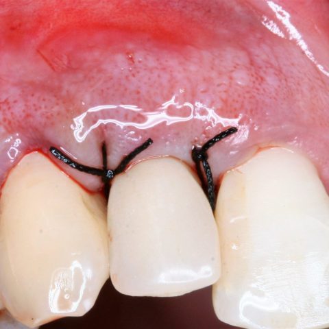 FUD-Dentes-da-frente-Incisivo-lateral_1-6-Final-da-cirurgia
