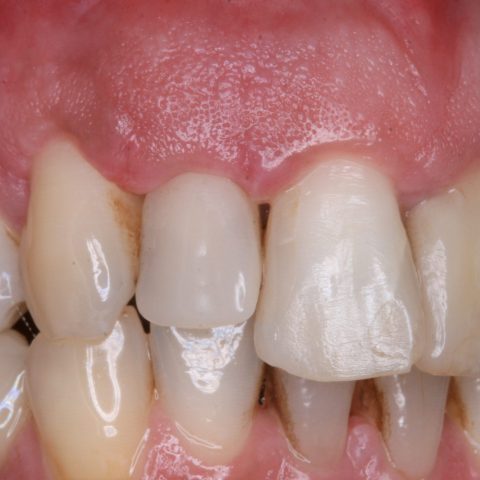 FUD-Dentes-da-frente-Incisivo-lateral_1-7-2-semanas-de-evolução