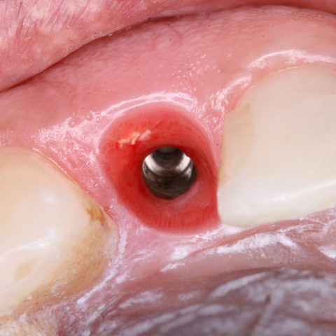 FUD-Dentes-da-frente-Incisivo-lateral_1-8-Três-meses-de-evolução-(aspeto-dos-tecidos)