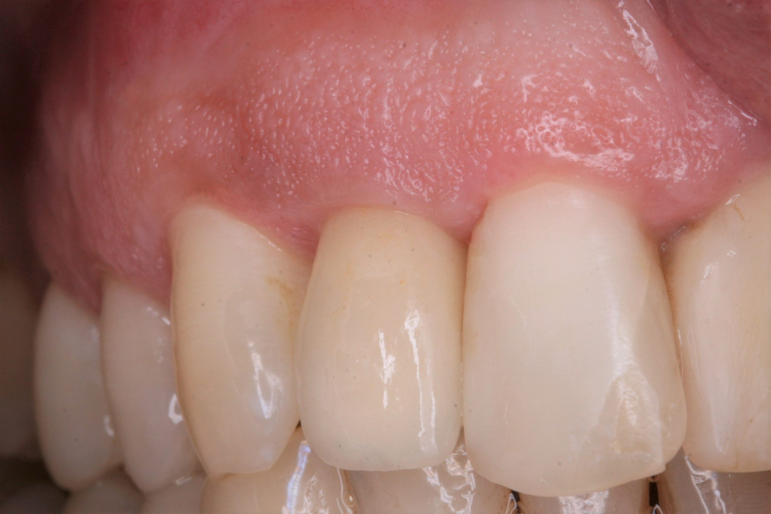 FUD-Dentes-da-frente-Incisivo-lateral_1-9-Aspeto-final