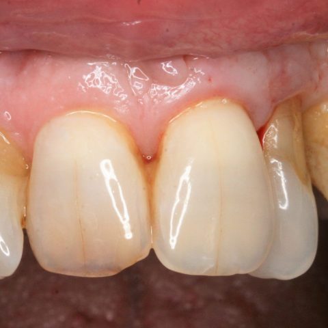FUD-Dentes-da-frente-Incisivo-lateral_2-1-Início
