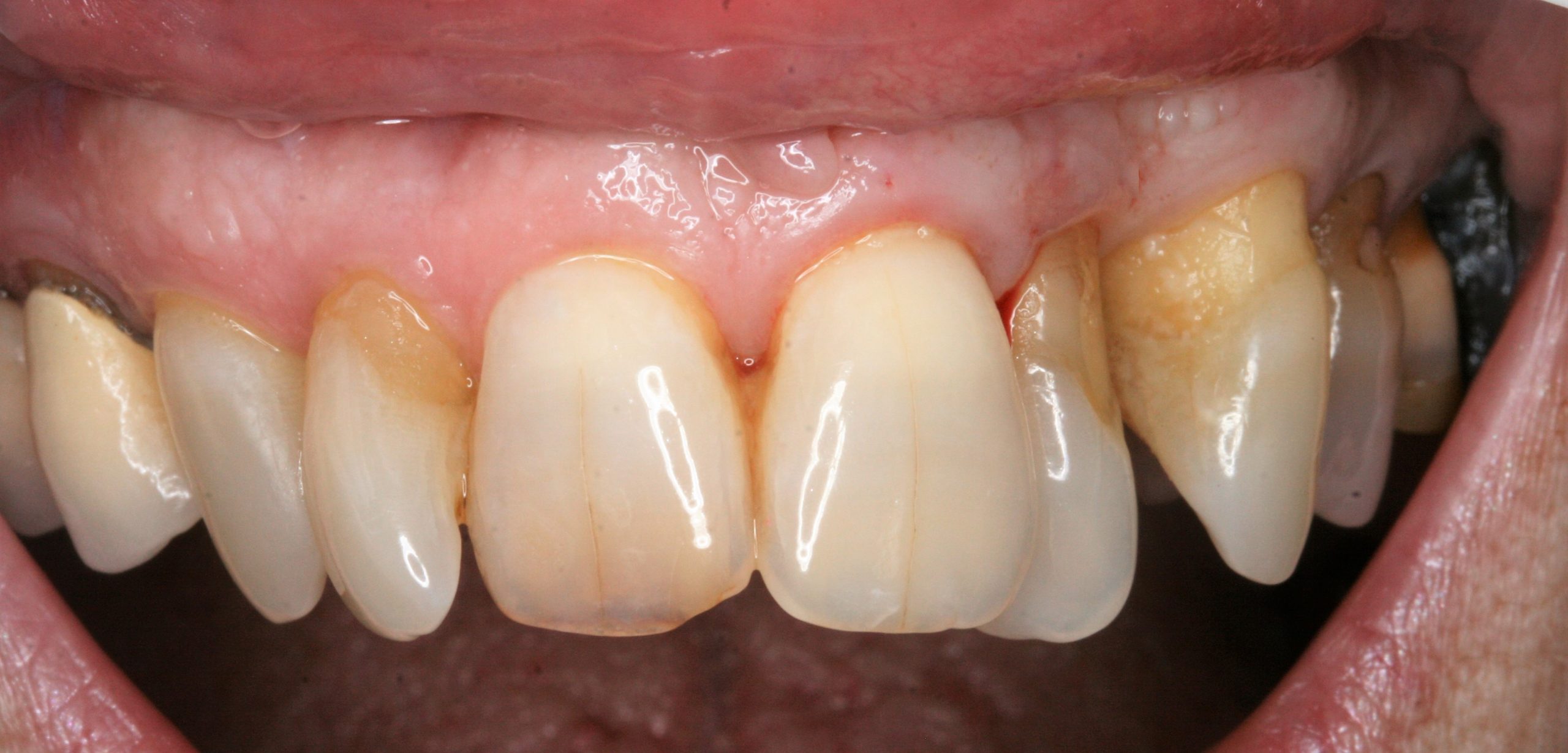 FUD-Dentes-da-frente-Incisivo-lateral_2-1-Início