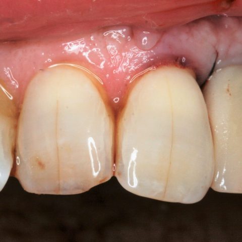 FUD-Dentes-da-frente-Incisivo-lateral_2-3-Dente-provisório