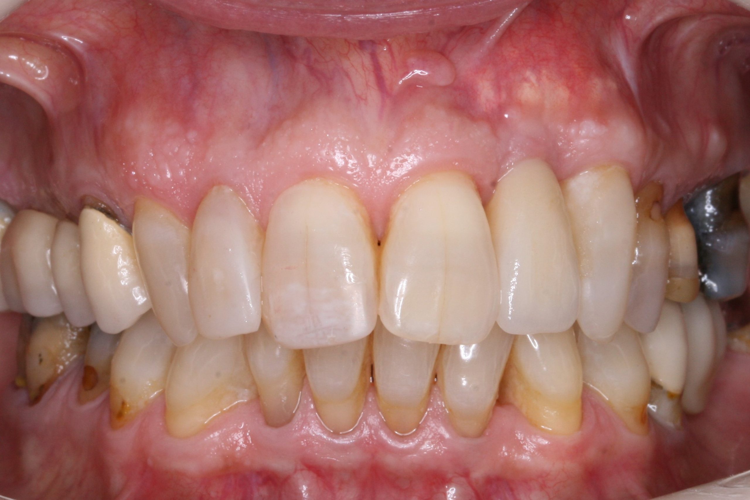 FUD-Dentes-da-frente-Incisivo-lateral_2-4-Aspeto-final