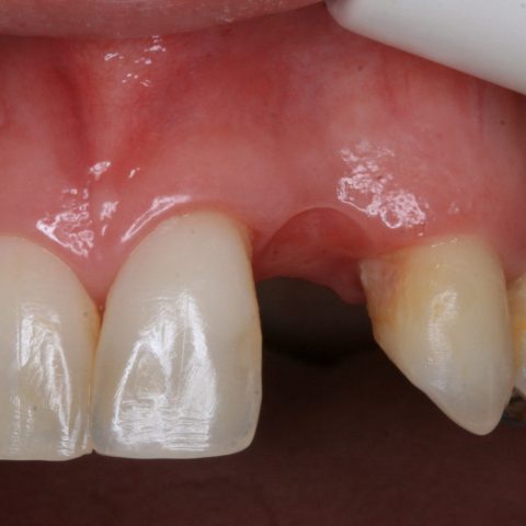 FUD-Dentes-da-frente-Incisivo-lateral_3-1