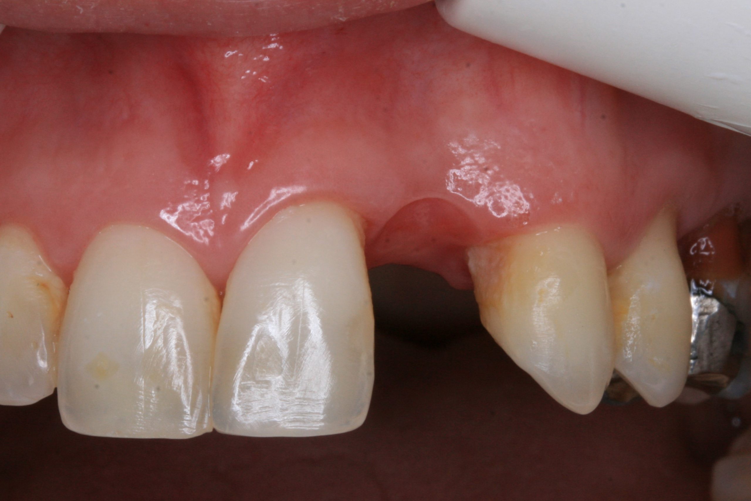 FUD-Dentes-da-frente-Incisivo-lateral_3-1