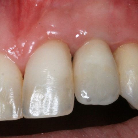 FUD-Dentes-da-frente-Incisivo-lateral_3-3