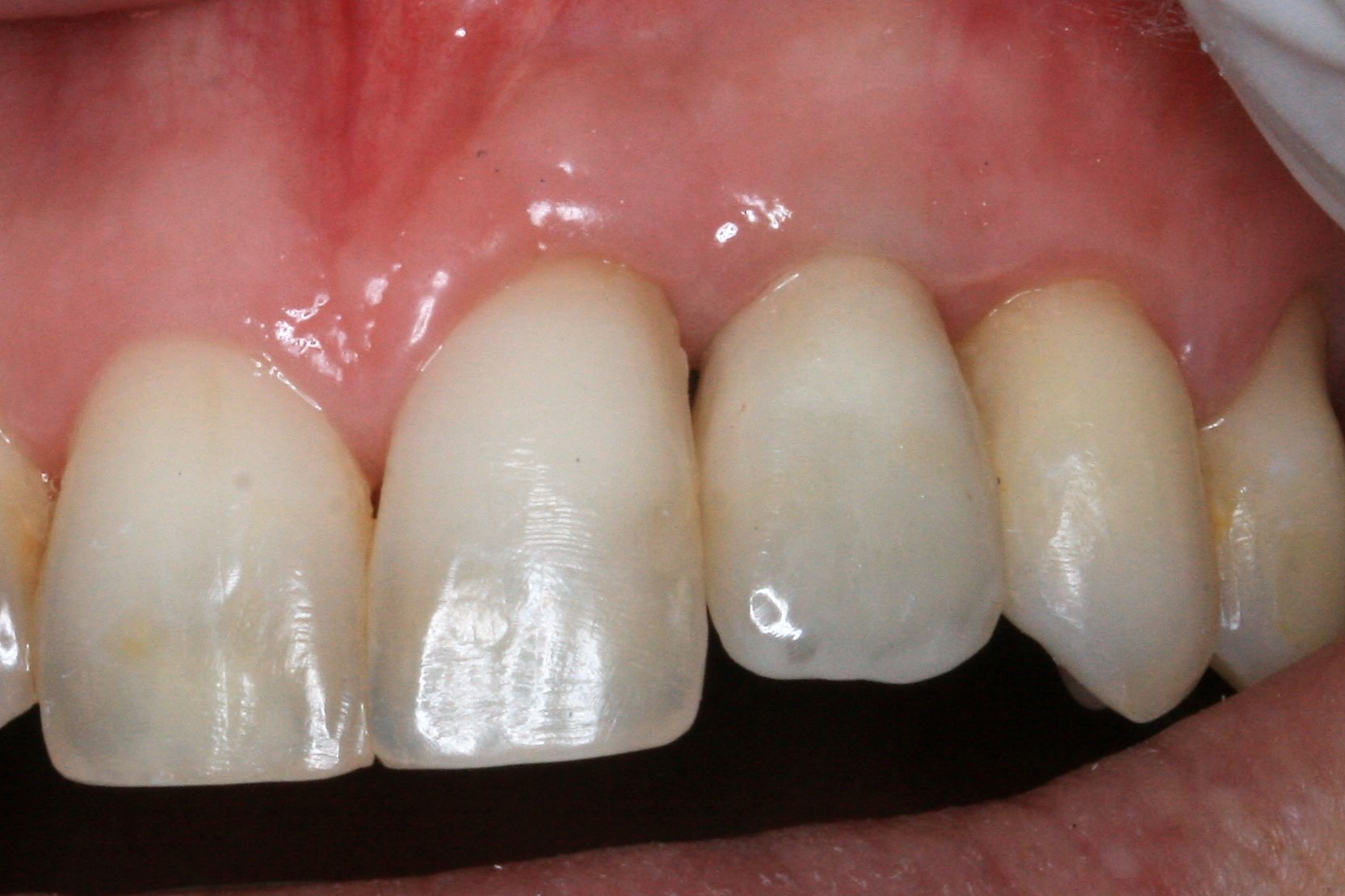 FUD-Dentes-da-frente-Incisivo-lateral_3-3
