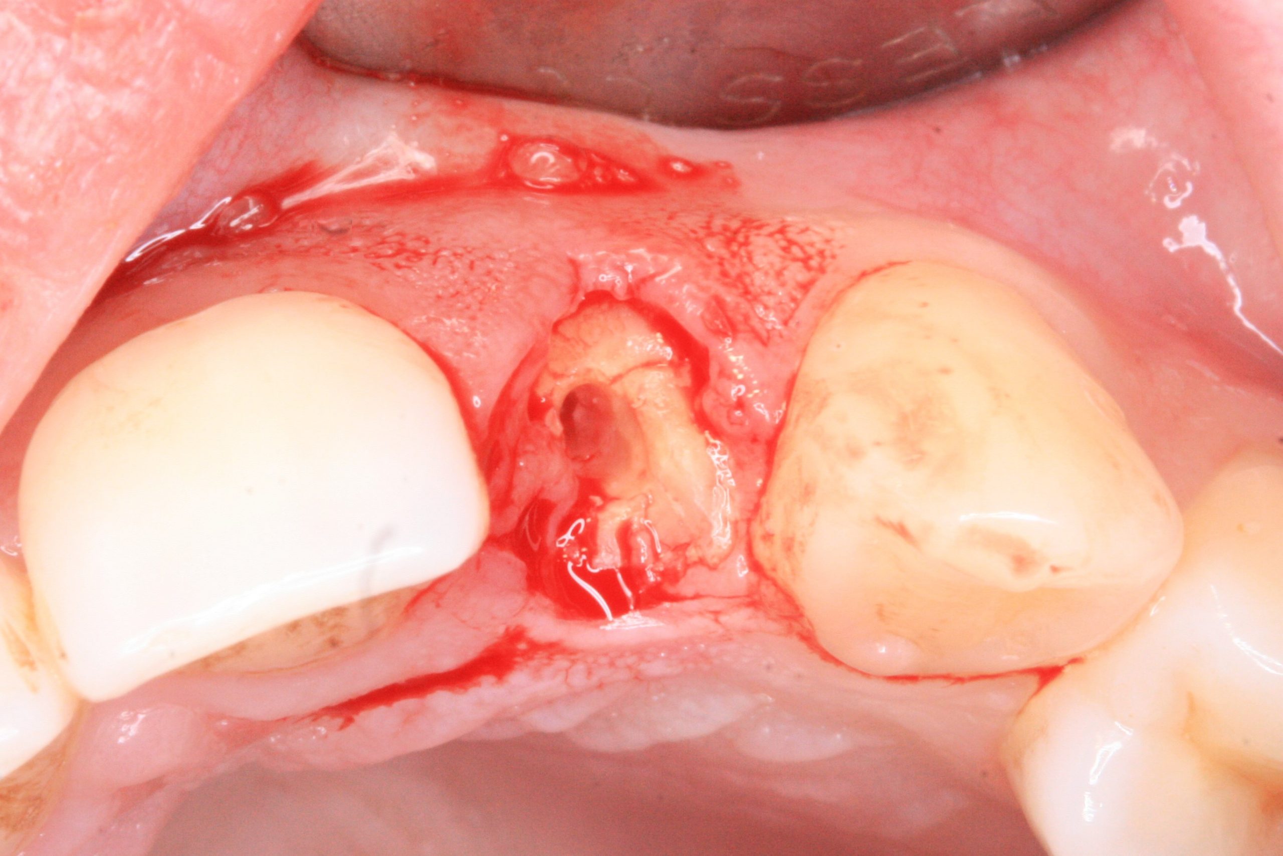 FUD-Dentes-da-frente-Incisivo-lateral_4-1-Início