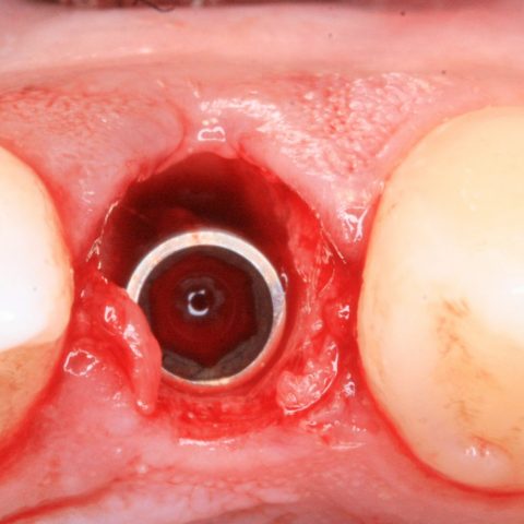 FUD-Dentes-da-frente-Incisivo-lateral_4-2-Implante-colocado