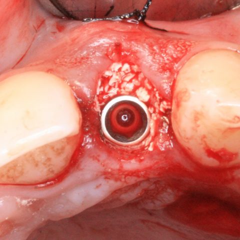 FUD-Dentes-da-frente-Incisivo-lateral_4-3-Implante-enxerto-de-tecido-conjuntivo-e-xenoenxertoósseo