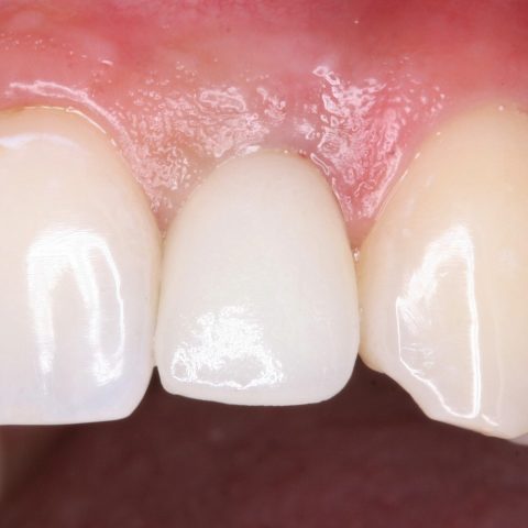 FUD-Dentes-da-frente-Incisivo-lateral_4-5-Aspeto-final