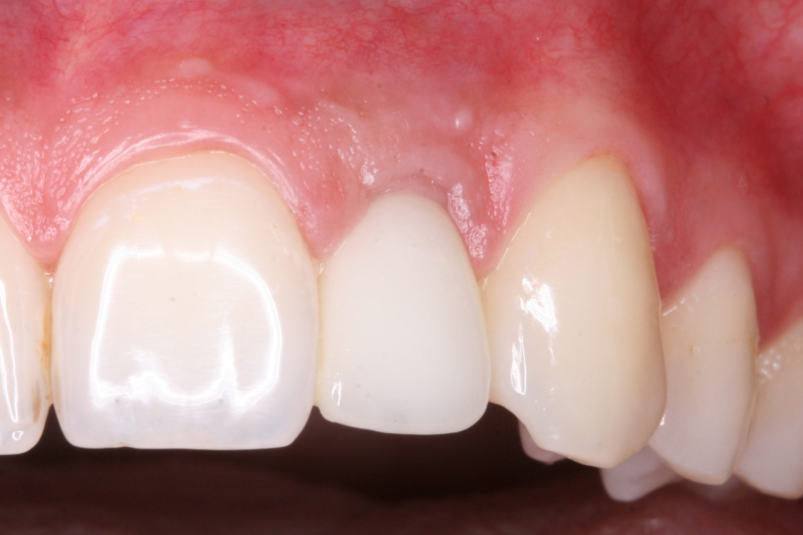 FUD-Dentes-da-frente-Incisivo-lateral_4-6-Dois-anos-de-evolução