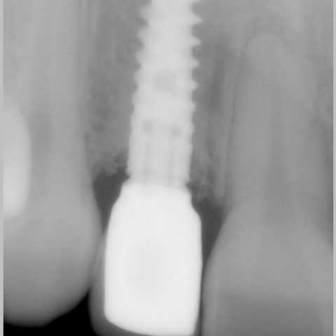 FUD-Dentes-da-frente-Incisivo-lateral_4-7-Radiografia-com-2-anos-de-evolução