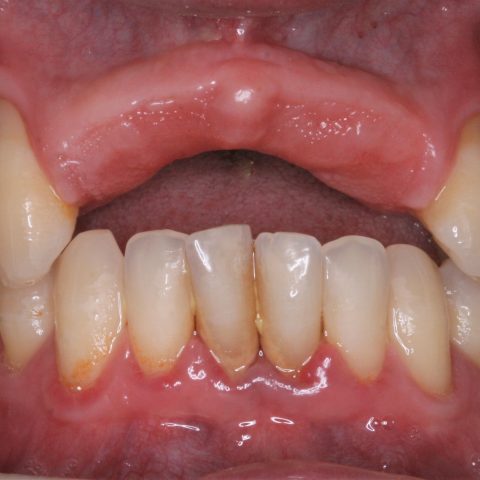 FUD-Dentes-da-frente-Ponte-provisória-anterior-1-Inicio
