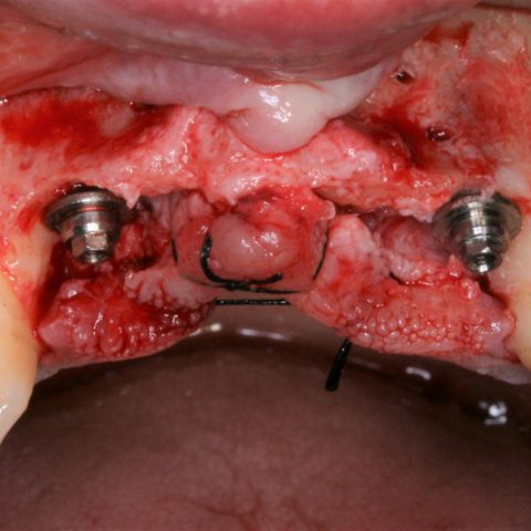 FUD-Dentes-da-frente-Ponte-provisória-anterior-2-Implantes-colocados