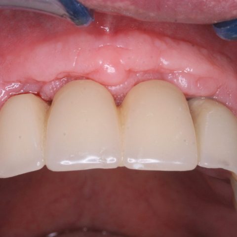 FUD-Dentes-da-frente-Ponte-provisória-anterior-4-Um-mês-de-evolução