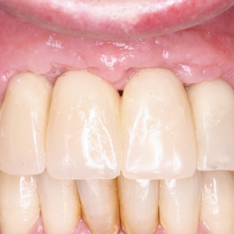 FUD-Dentes-da-frente-Ponte-provisória-anterior-5-Modificação-dos-provisórios