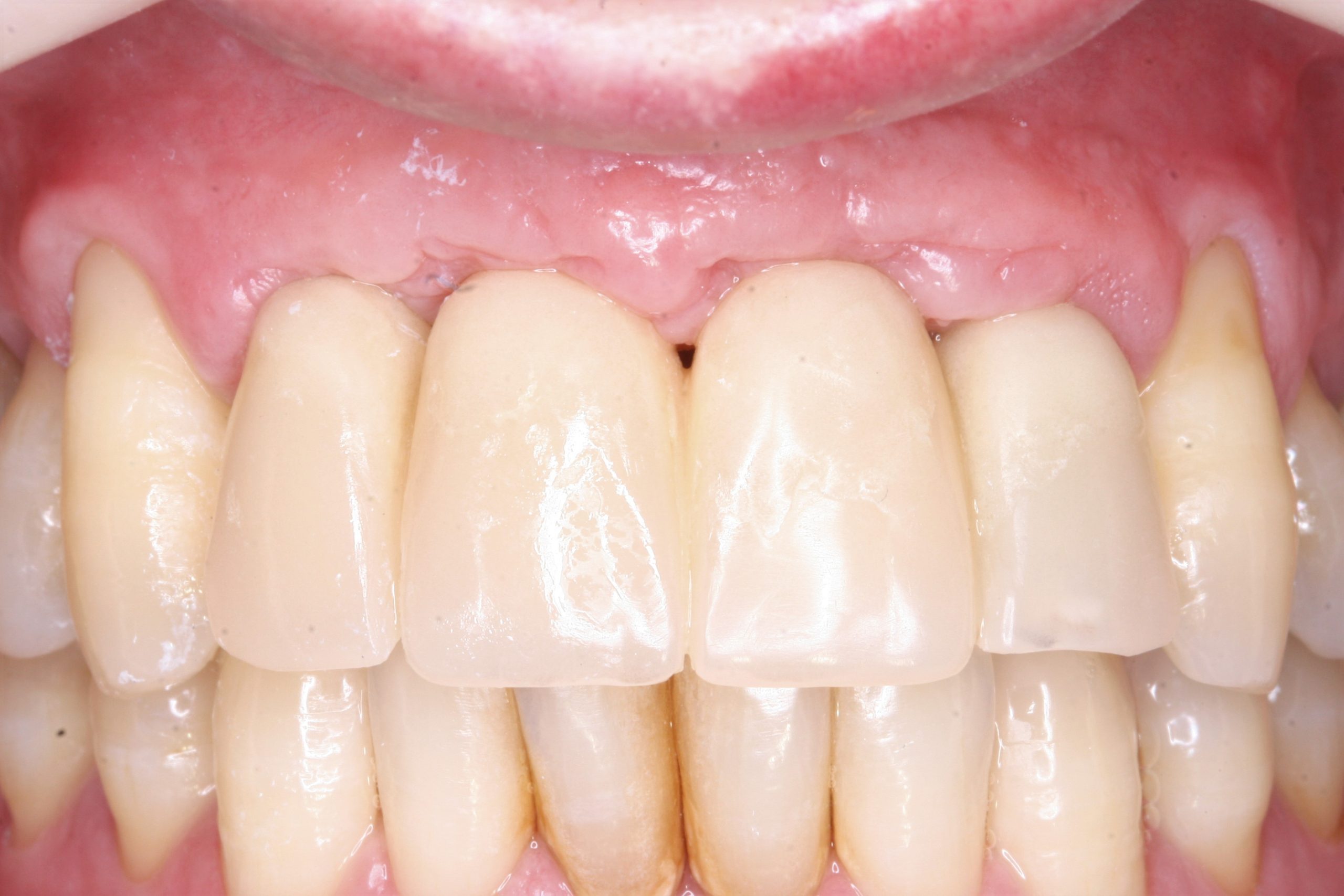 FUD-Dentes-da-frente-Ponte-provisória-anterior-5-Modificação-dos-provisórios