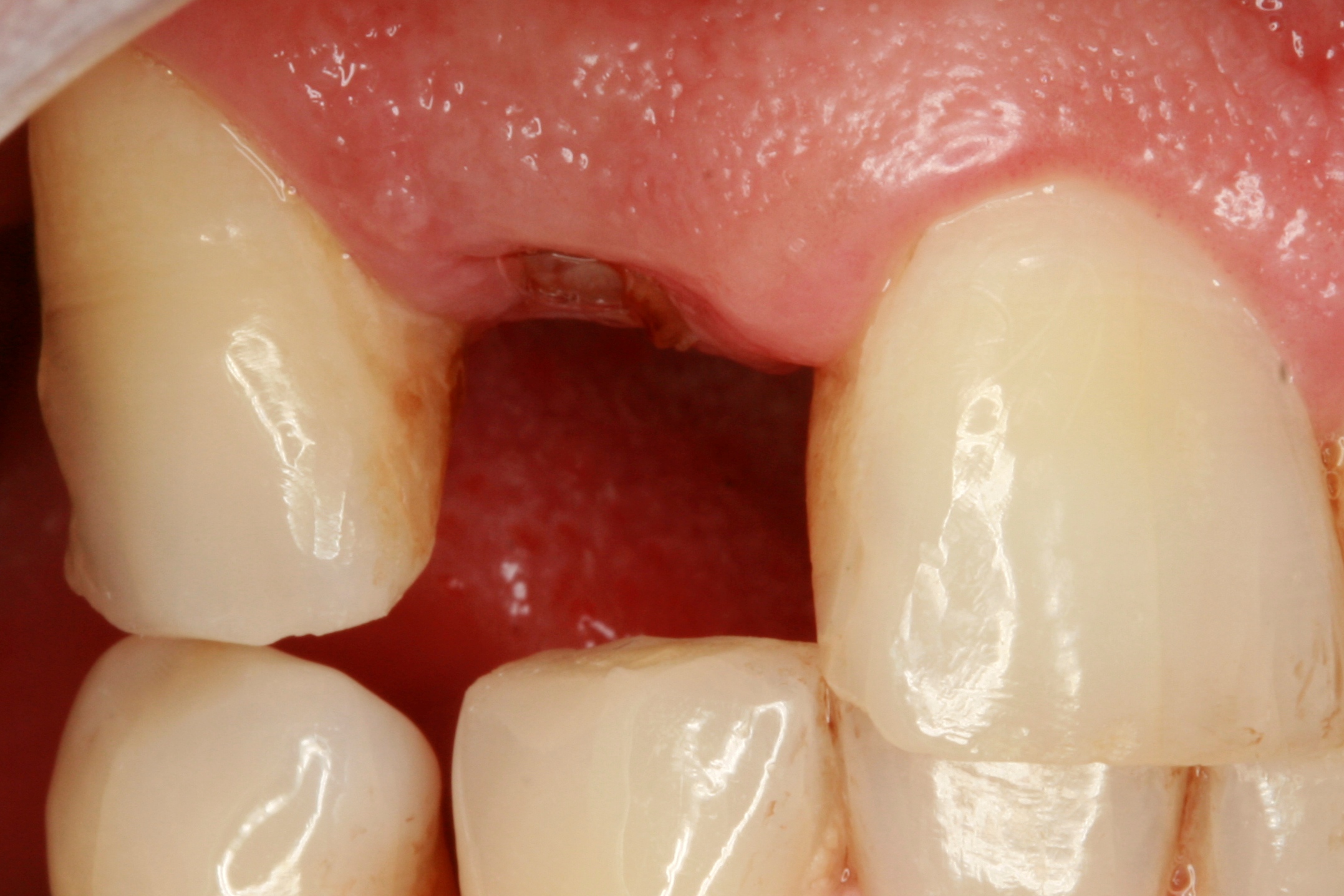 FUD-Dentes-da-frente-Provisório-anterior_1-1