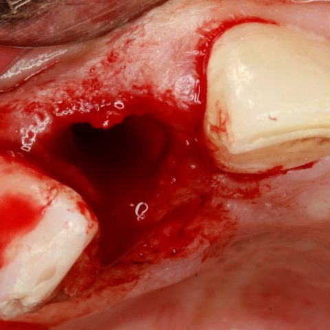 FUD-Dentes-da-frente-Provisório-anterior_1-3