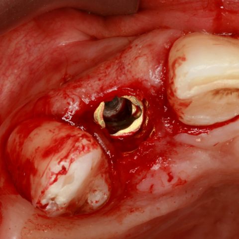 FUD-Dentes-da-frente-Provisório-anterior_1-4