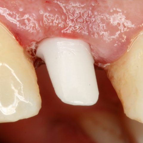 FUD-Dentes-da-frente-Provisório-anterior_1-5