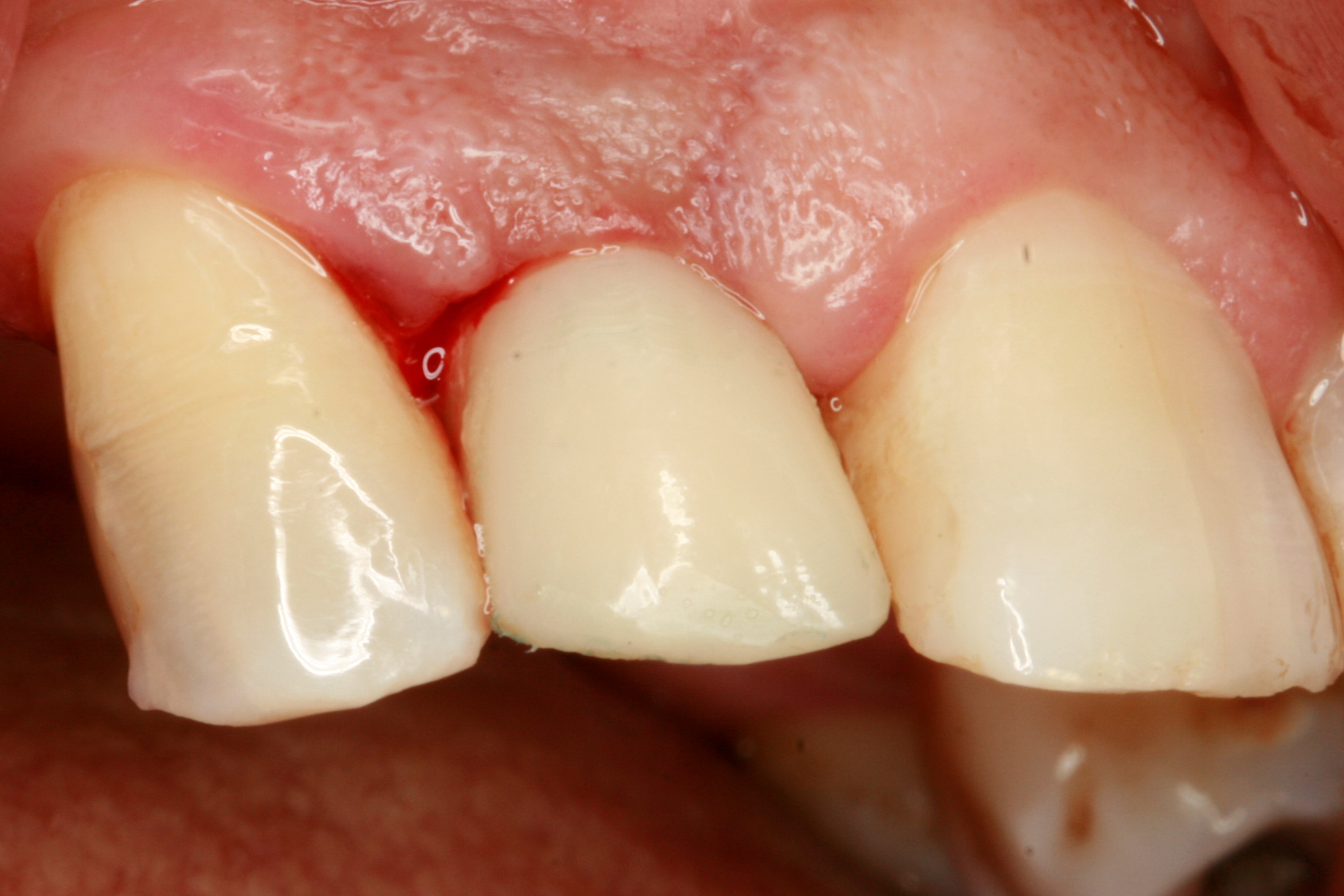 FUD-Dentes-da-frente-Provisório-anterior_1-6