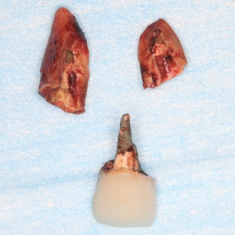 FUD-Dentes-da-frente-Provisório-anterior_2-2-Dente-fraturado