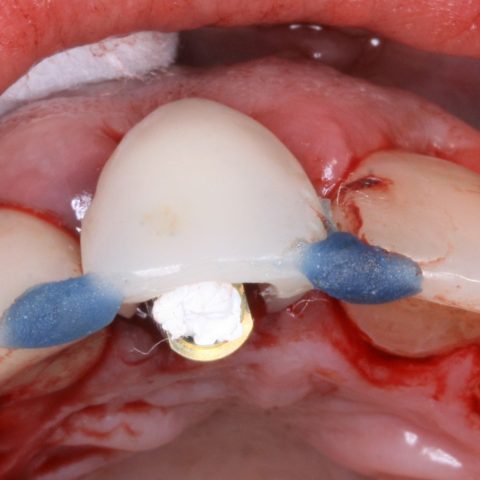 FUD-Dentes-da-frente-Provisório-anterior_2-4-Preparação-do-provisório