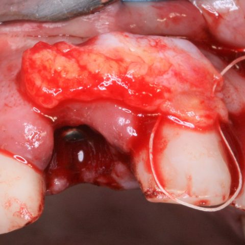 FUD-Dentes-da-frente-Provisório-anterior_2-5-Enxerto-de-tecido-conjuntivo