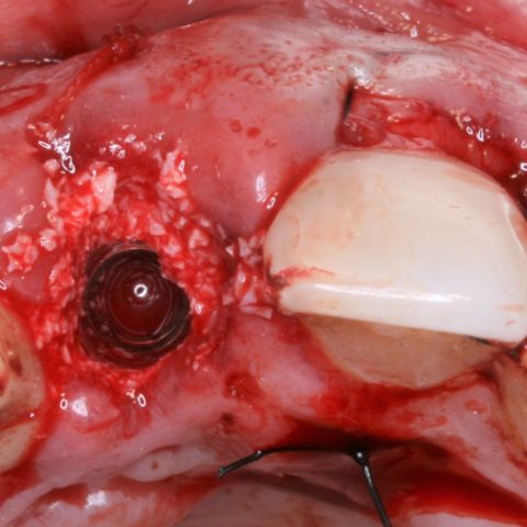 FUD-Dentes-da-frente-Provisório-anterior_2-6-Implante,-xenoenxerto-ósseo-e-enxerto-de-conjuntivo