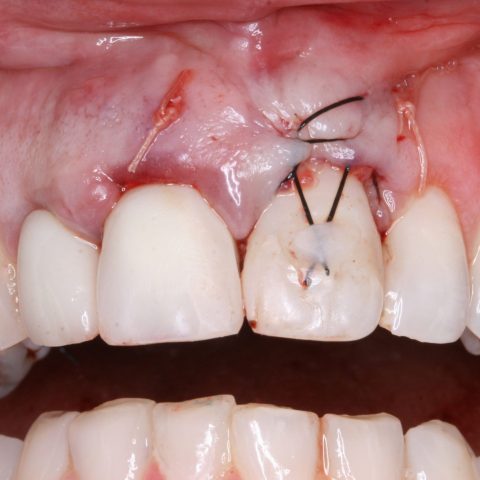 FUD-Dentes-da-frente-Provisório-anterior_2-7-Final-da-cirurgia