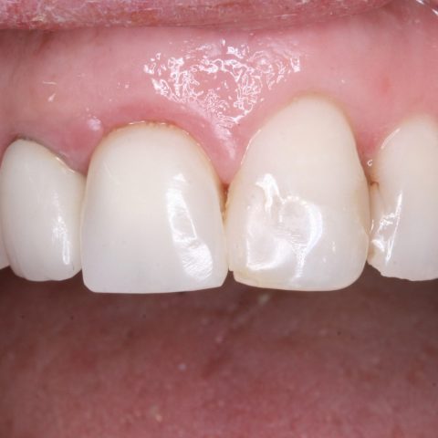 FUD-Dentes-da-frente-Provisório-anterior_2-8-Um-mês-de-evolução