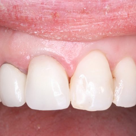 FUD-Dentes-da-frente-Provisório-anterior_2-9-Modificação-do-provisório